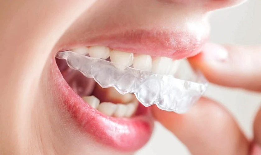 5 lý do niềng răng Invisalign được ưa chuộng tại Nha khoa Quốc tế Phú Hòa