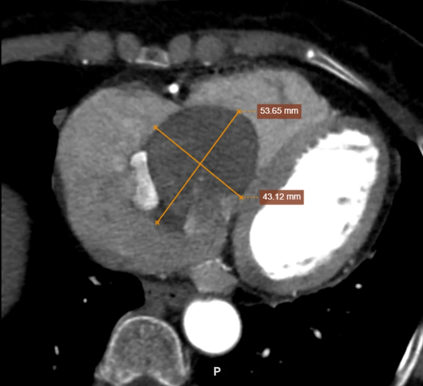 Đi khám zona thần kinh, bất ngờ phát hiện khối u khổng lồ trong tim