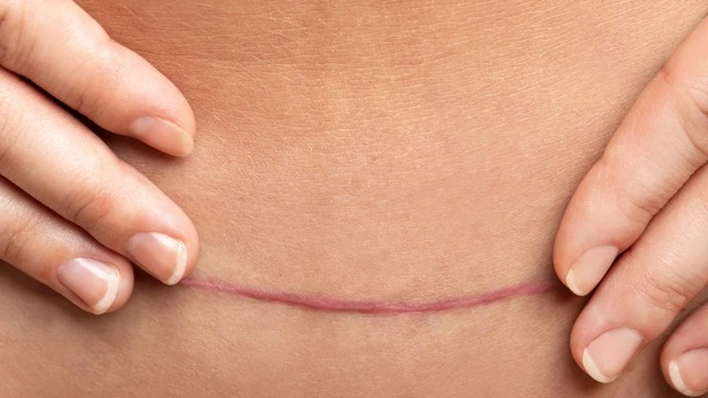 Để vết mổ sau sinh mau lành và không để lại sẹo