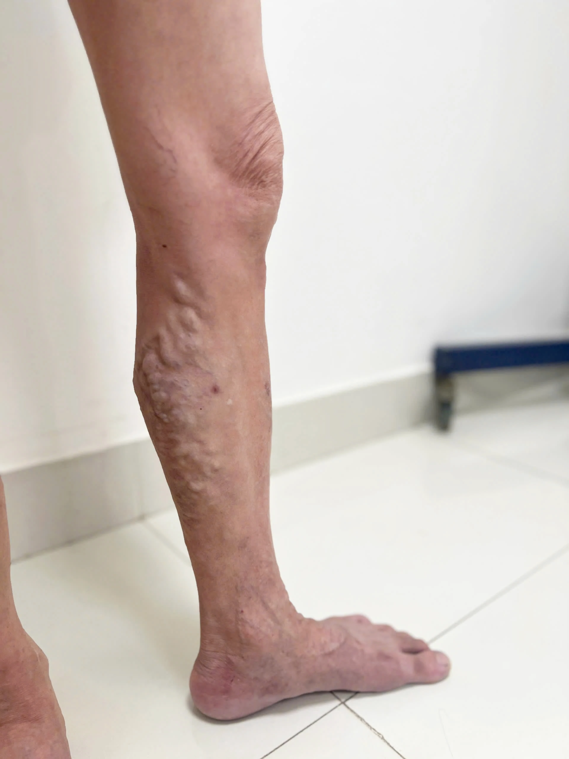 Hồi sinh đôi chân khoẻ đẹp chỉ sau một lần can thiệp